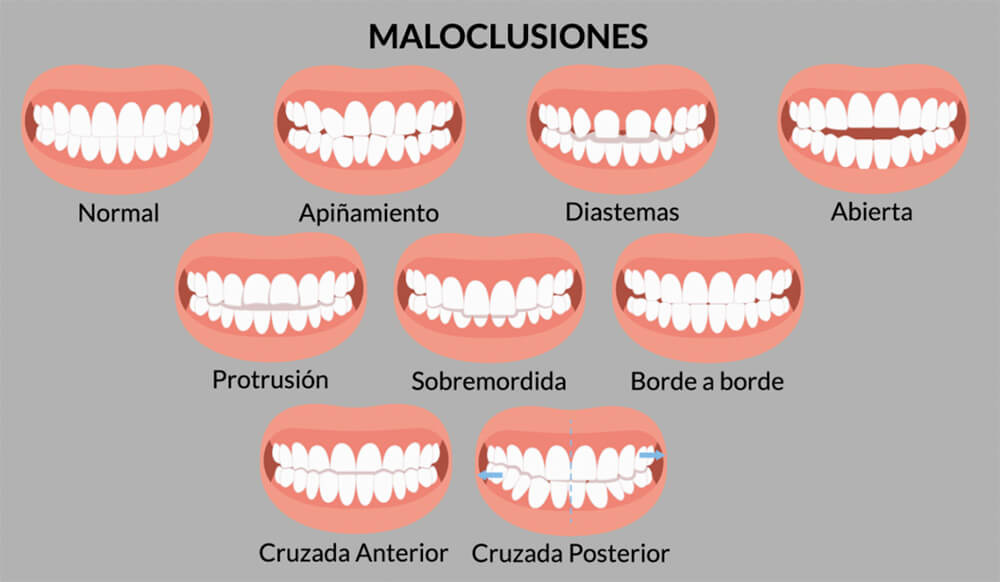 maloclusiones